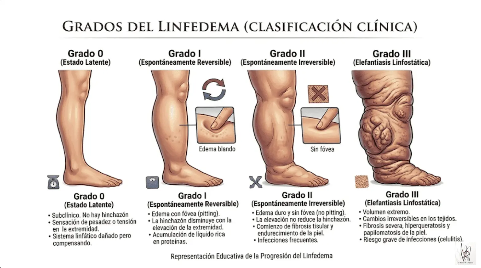 Grados de Linfedema